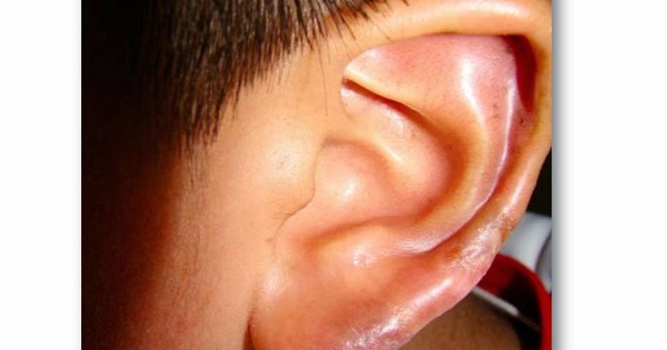 Patologias De Oido Dermatitis Del Pabellon Auricular