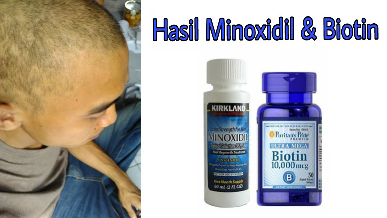 Миноксидил форум. Миноксидил. Minoxidil состав. Миноксидил для волос для мужчин. Миноксидил схема.