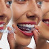 Thanh thiếu niên có nên chọn niềng răng invisalign?