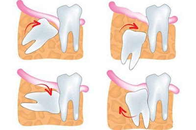 nhổ bỏ răng khôn mọc lệch