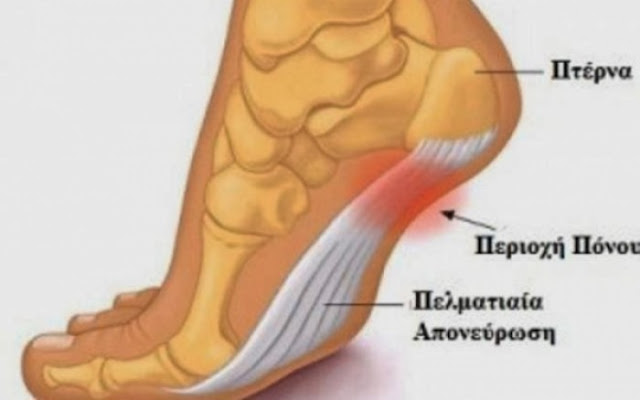 Άκανθα πτέρνας: Τι είναι και πώς θα την ξεπεράσετε  
