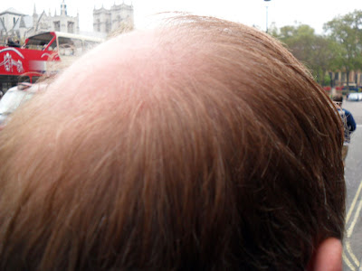 Bald Spot 2 - Opposite Big Ben