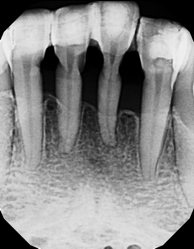Ask Dr. Spindel Ribbond splinting?
