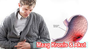 pengobatan almi maag manjur: Ciri tanda maag sembuh total ini yang