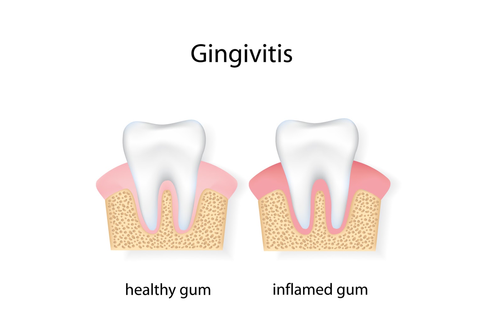 Regency Dental Group How to Recognize Those Early Signs of Gingivitis