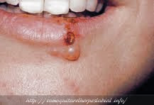 Quitar herpes labial en un dia