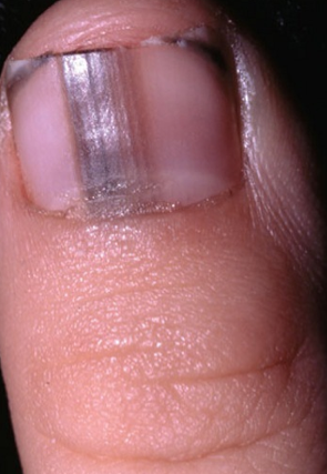 Health Info and Tips: Nail Can Describe Your Health