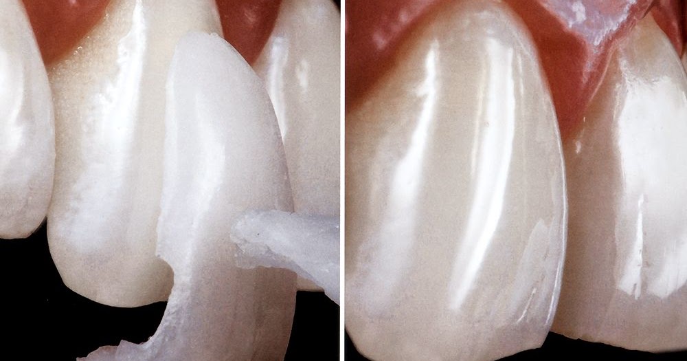 RESTAURAÇÕES ESTÉTICAS : Diferença entre faceta em resina e porcelana