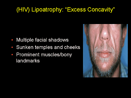 HIDUP MESTI DITERUSKAN: KESAN STAVUDINE - d4T DALAM HAART 