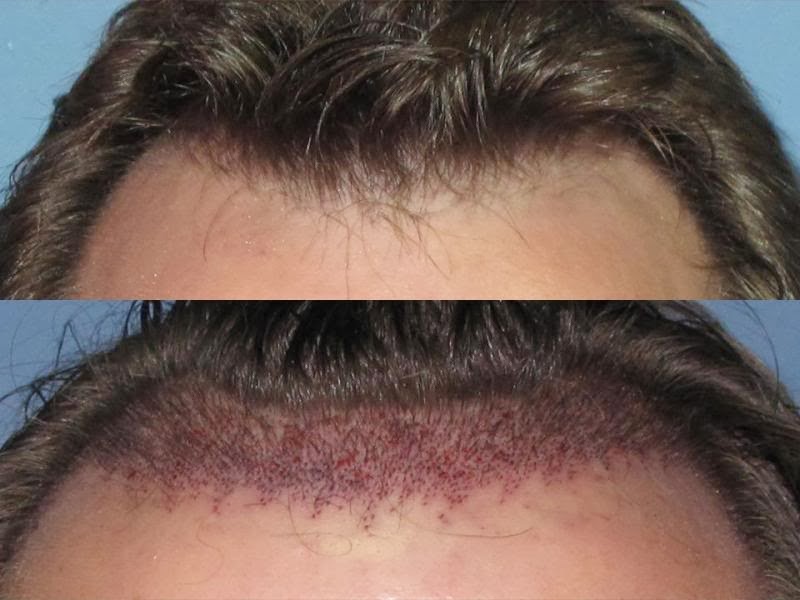 nicebeauty Hair Plantation for Men, Cost & Before & After Picture