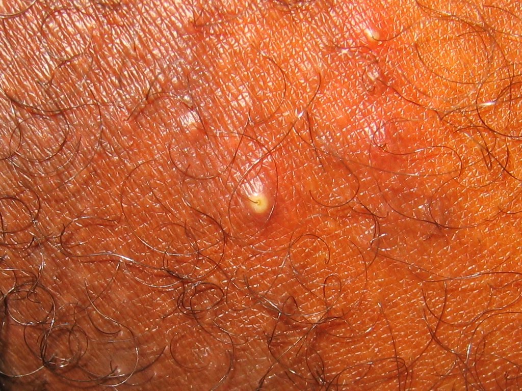 HEALTH FROM TRUSTED SOURCES: MRSA Infections of the Skin
