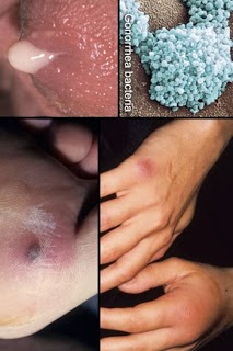 Gambar Penyakit Sipilis