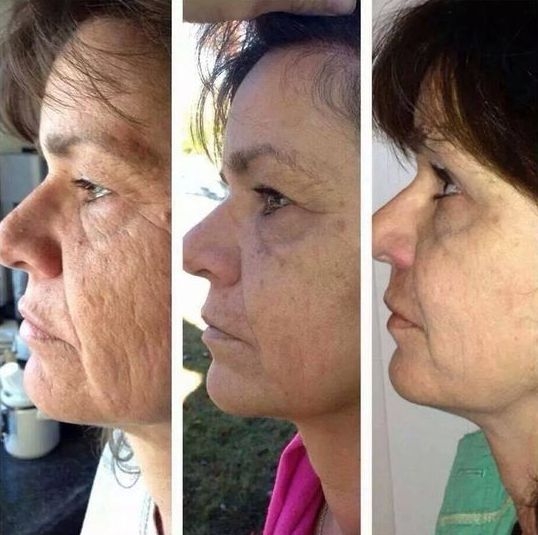 Ways To Tighten Jowls And Remove Sagging Cheeks With Face Workouts