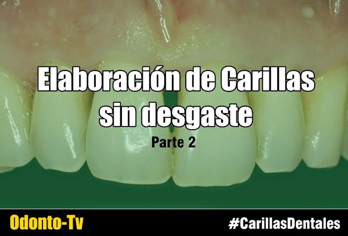 CURSO de Carillas sin desgaste paso a paso (Video 2)