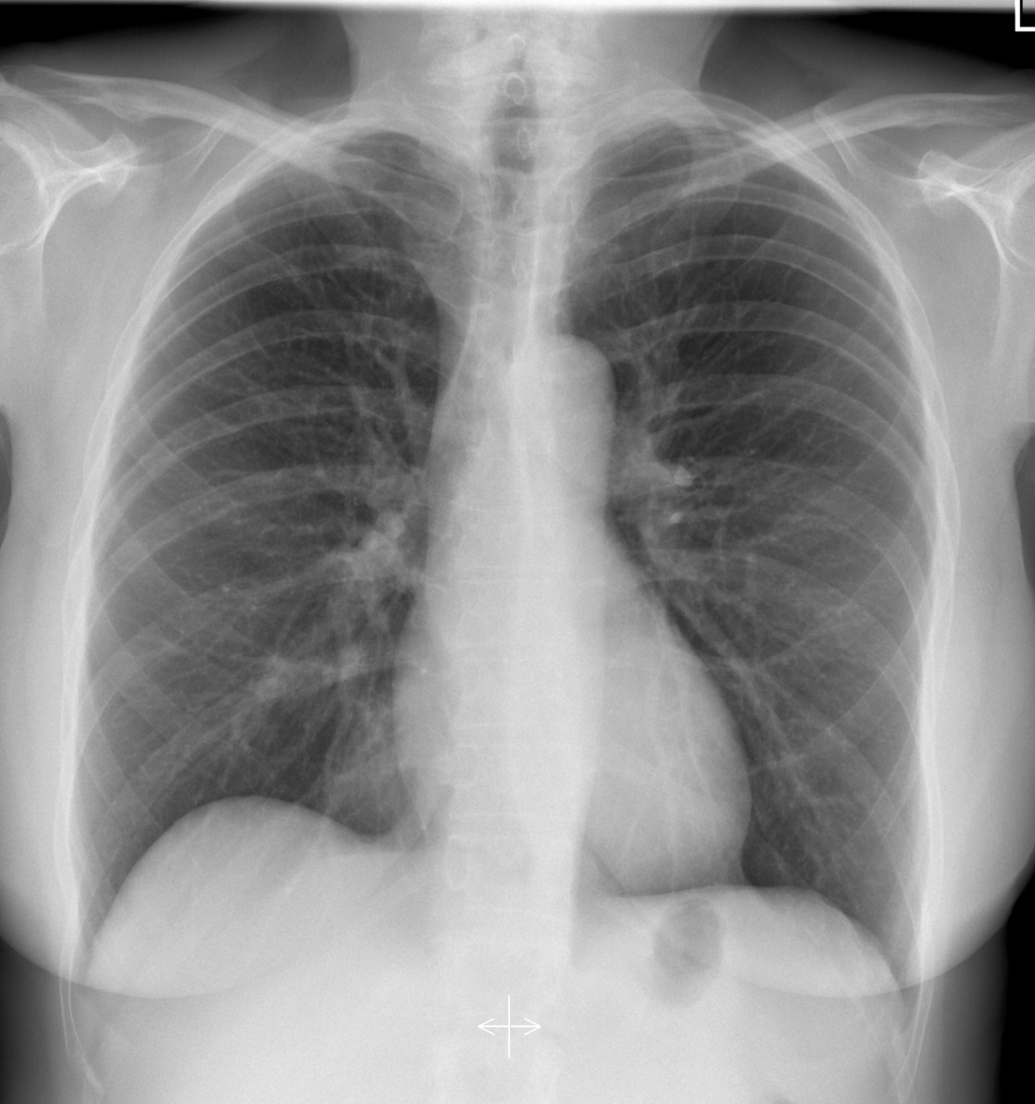 Dr smith s ecg blog a woman with 8 hours of ongoing crushing chest