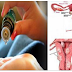 Using These 5 Effective Home Remedies Get Rid Of Cysts And Fibroids Naturally And Quick!