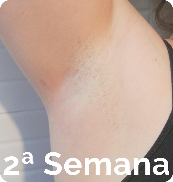 Philips lumea opinión antes después