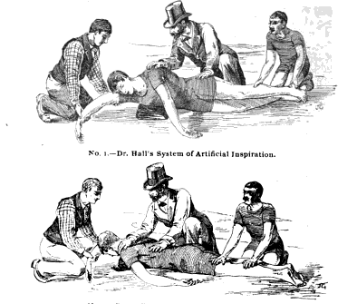 Harvesting rain water udupi revolutionises district Asthma History: 1750-1950: Methods of Manual Resuscitation