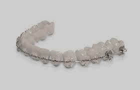 http://www.dentistinchennai.com/braces.php