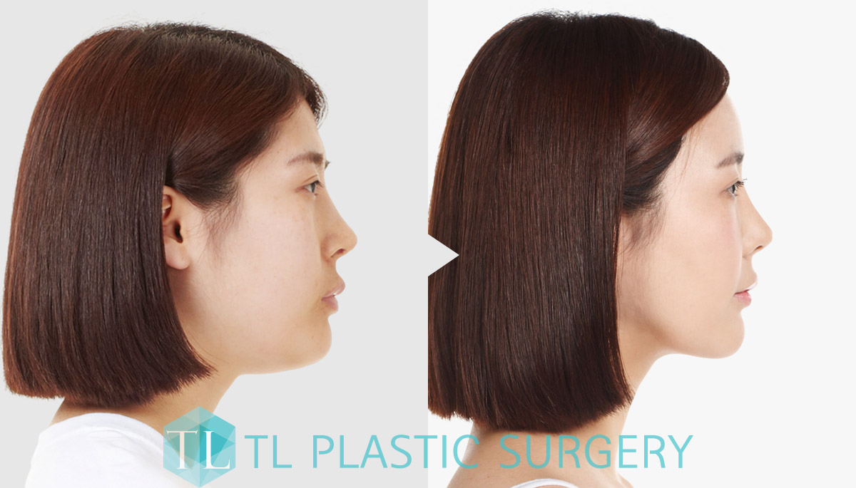 Potong lemak wajah ! Power V! TL PS Lifting Indonesia