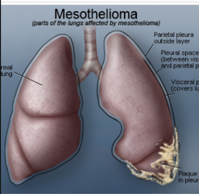 Mesothelioma diagnosis Cancer is