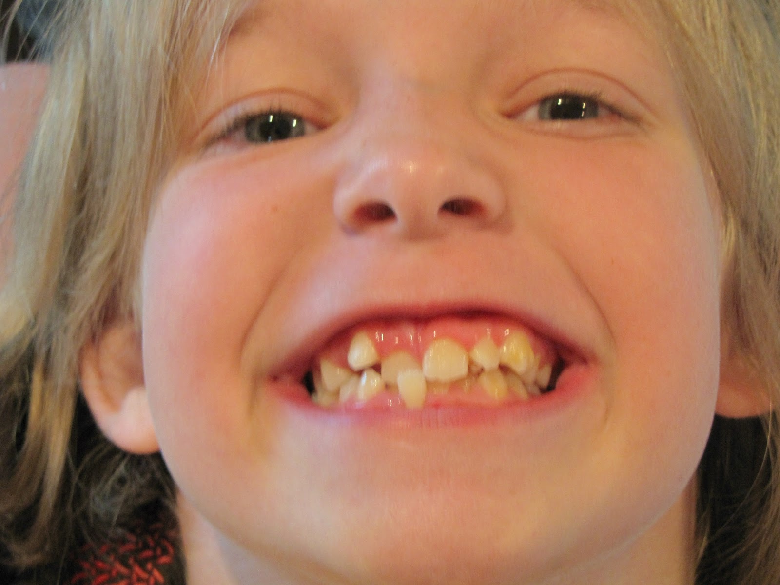 rocks-in-the-washer-before-and-after-braces