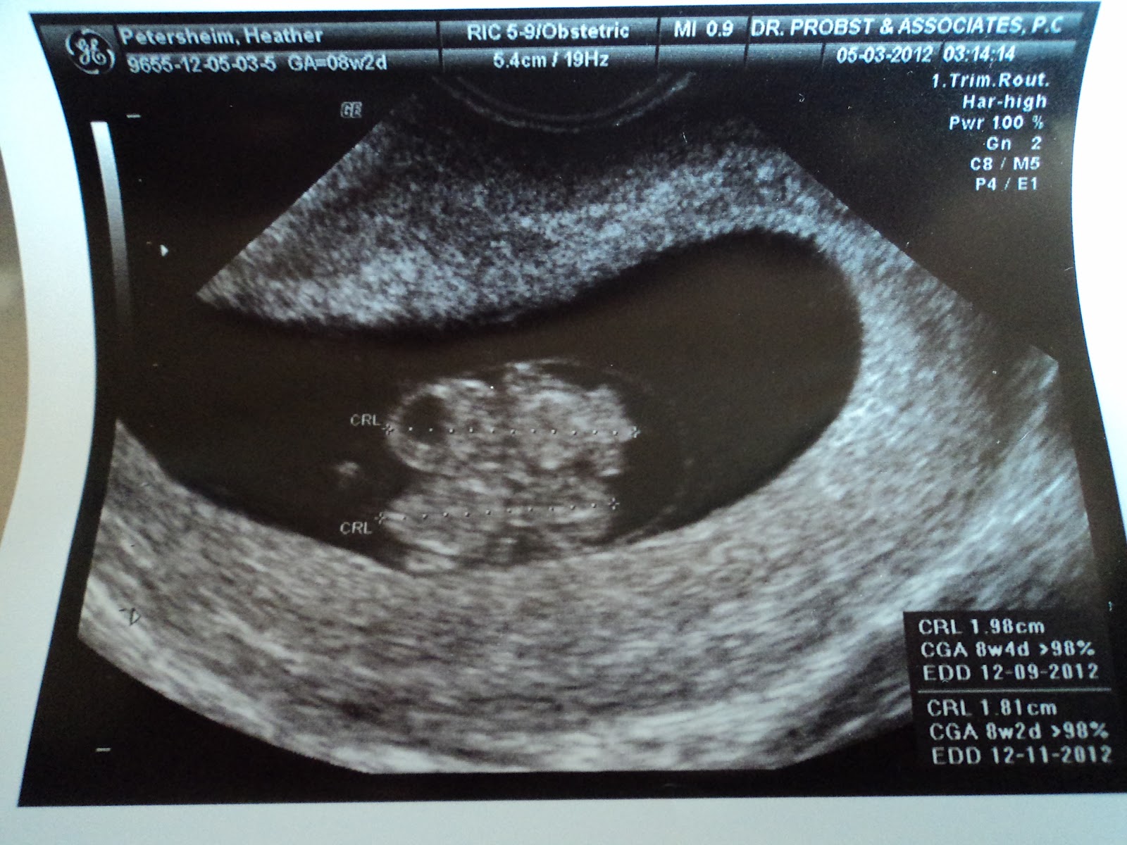 Ultrasound Pictures Of Momo Twins at Jordan Moncrieff blog