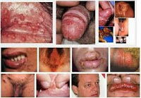 Nama Obat Sipilis Di Apotik Banyak Pakai Terbukti Sembuh Nama Obat Sipilis Di Apotik Banyak Pakai Terbukti Sembuh