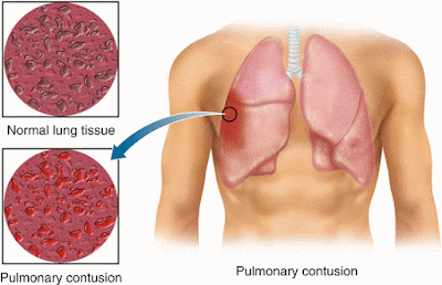 Pulmonary contusion ICD-10, Diagnosis, Recovery, Complications