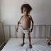 [Κόσμος] "Σιωπηλός πόλεμος "..Ξεχάστε τη Συρία ...Σε αυτή τη χώρα ..η χειρότερη κρίση..πείνας.. 