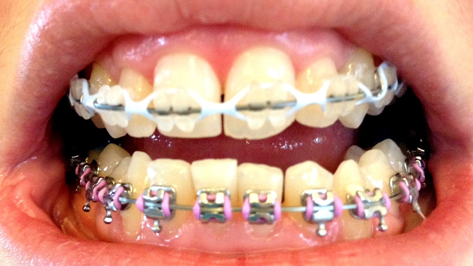 Braces Clear Bands On Braces Turn Yellow