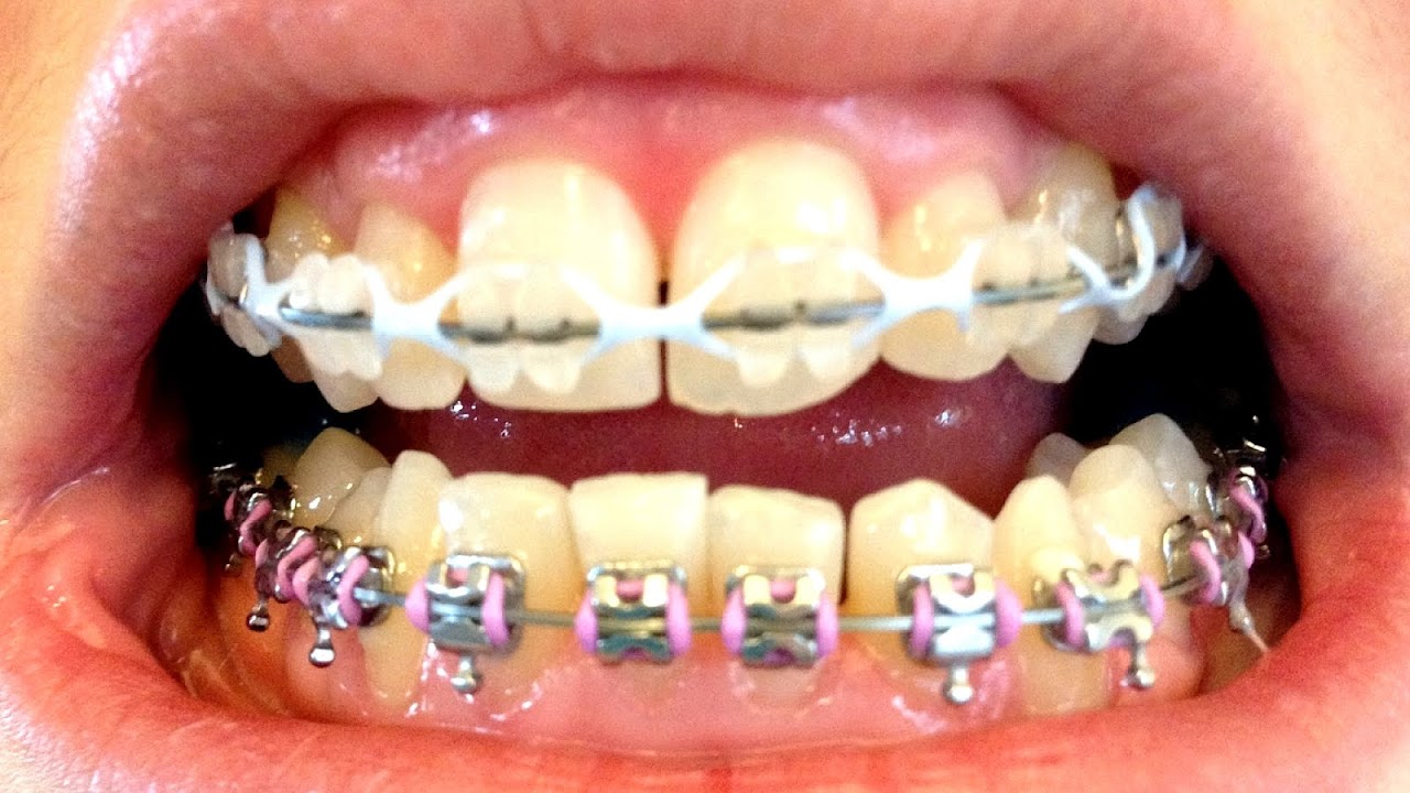 Braces With White Bands White Choices