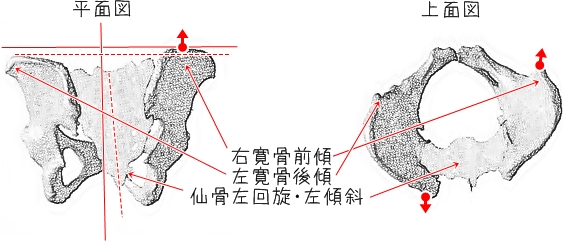 安部塾公式ブログ 身体操作指導者 安部吉孝: 骨盤の歪みを、わかりやすく図示してみた