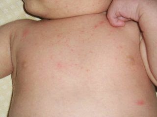 brufoli sulla fronte neonato
