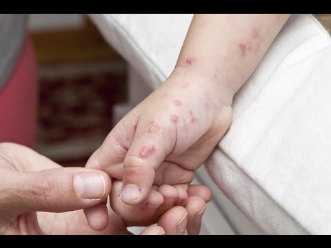 Iwan Pharm Sexually Transmitted Diseases Penyakit Menular