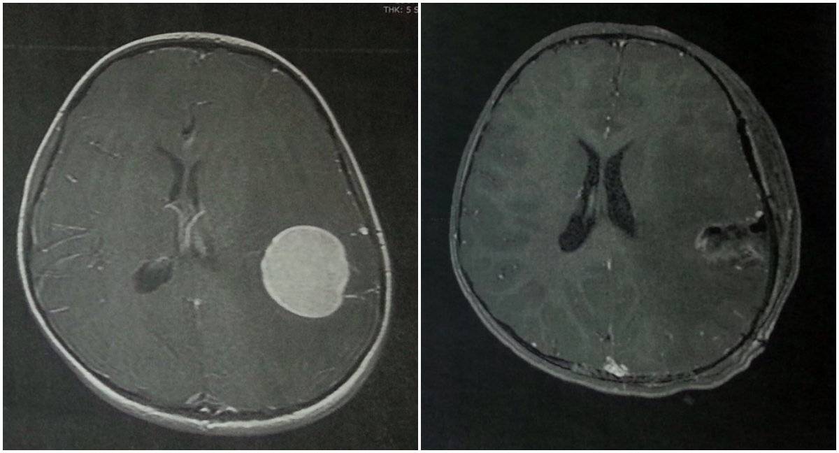 brain%2Btumor.jpg