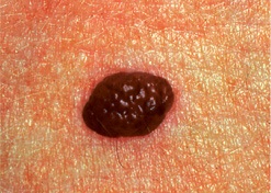 what are the symptoms of mole cancer what are the symptoms of mole cancer
