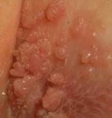 Image Obat Kondiloma Akuminata Ampuh Aman Dikonsumsi Pada Saat Hamil
