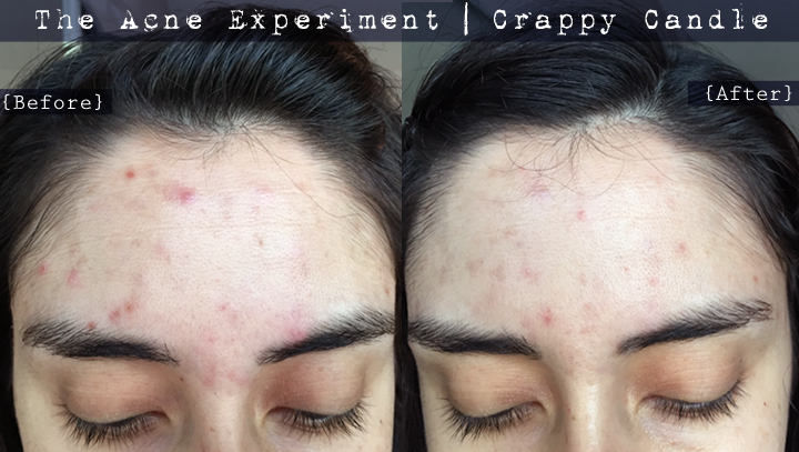 St. Ives Exfoliating Pads/Lactic Acid Before and After - The Acne Experiment