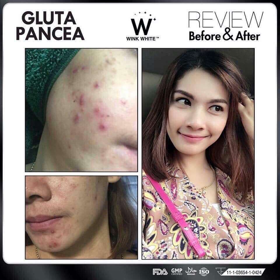 Glutathione While Breastfeeding