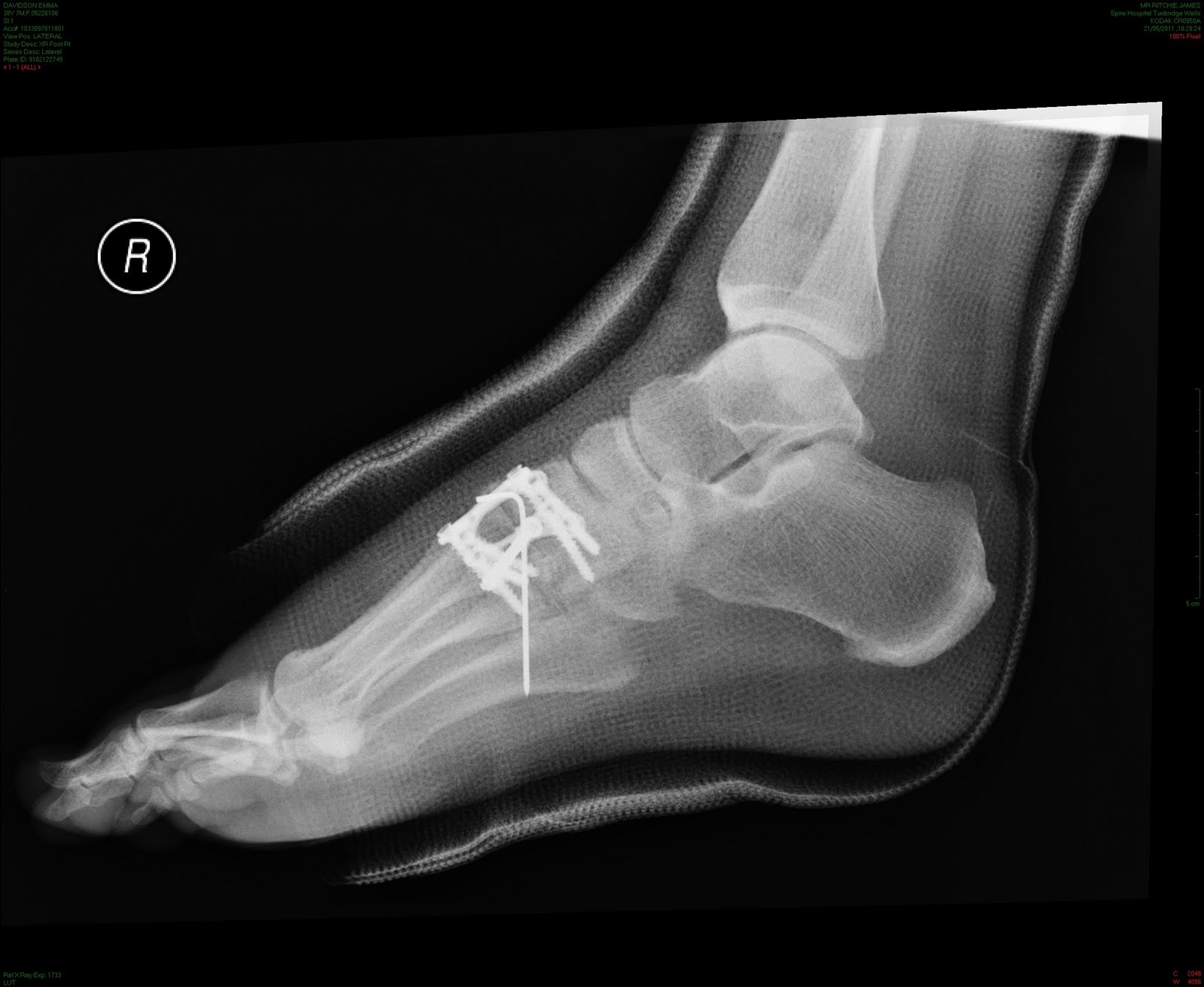 Yes I've got a Lisfranc injury too ! X rays & images of the foot