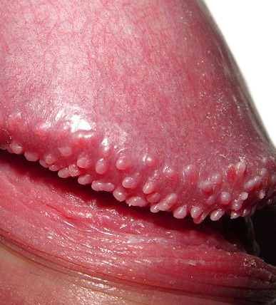 penile papules #11