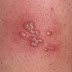 Gejala dan tanda-tanda penyakit herpes pada kulit