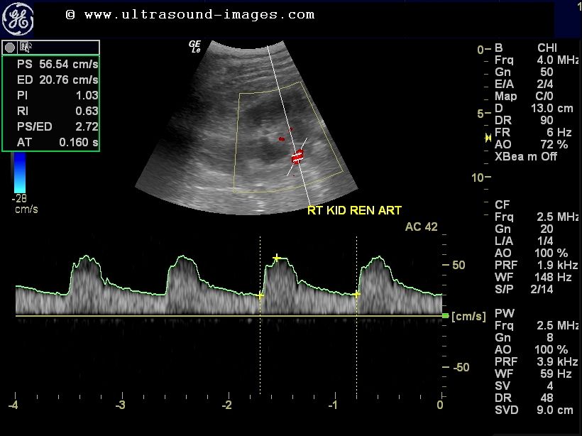 Normal Renal Artery Waveform Ultrasound