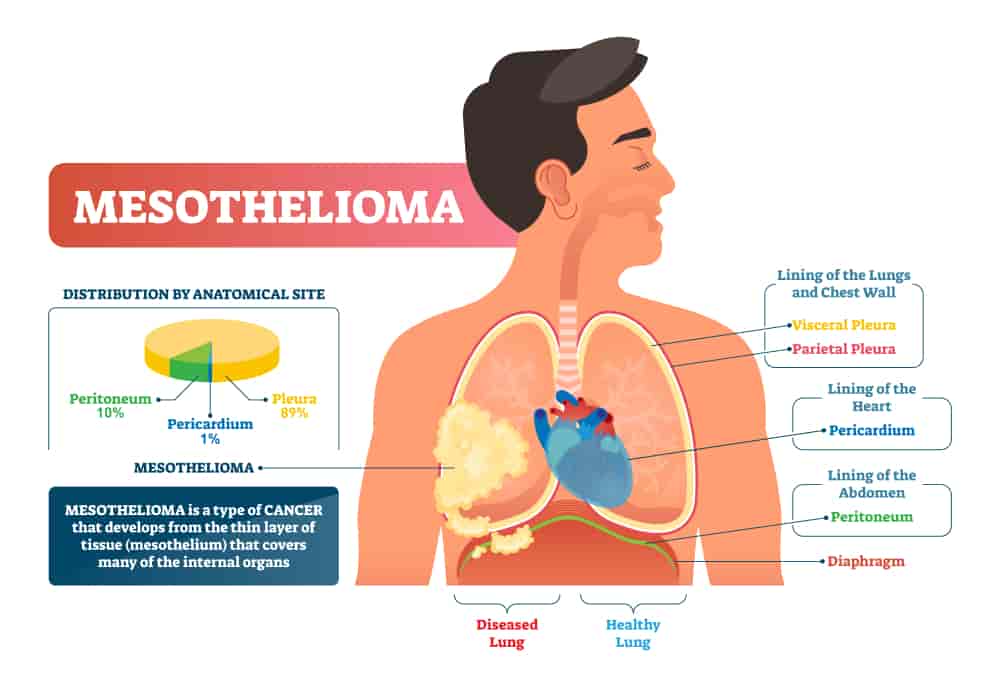 Mesothelioma Pictures and Mesothelioma Infographics IAS Exam Guide