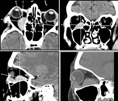 Orbital involvement in multiple myeloma