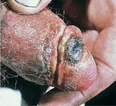 Penile pyoderma with necrotizing cellulitis in a man with secondary syphilis