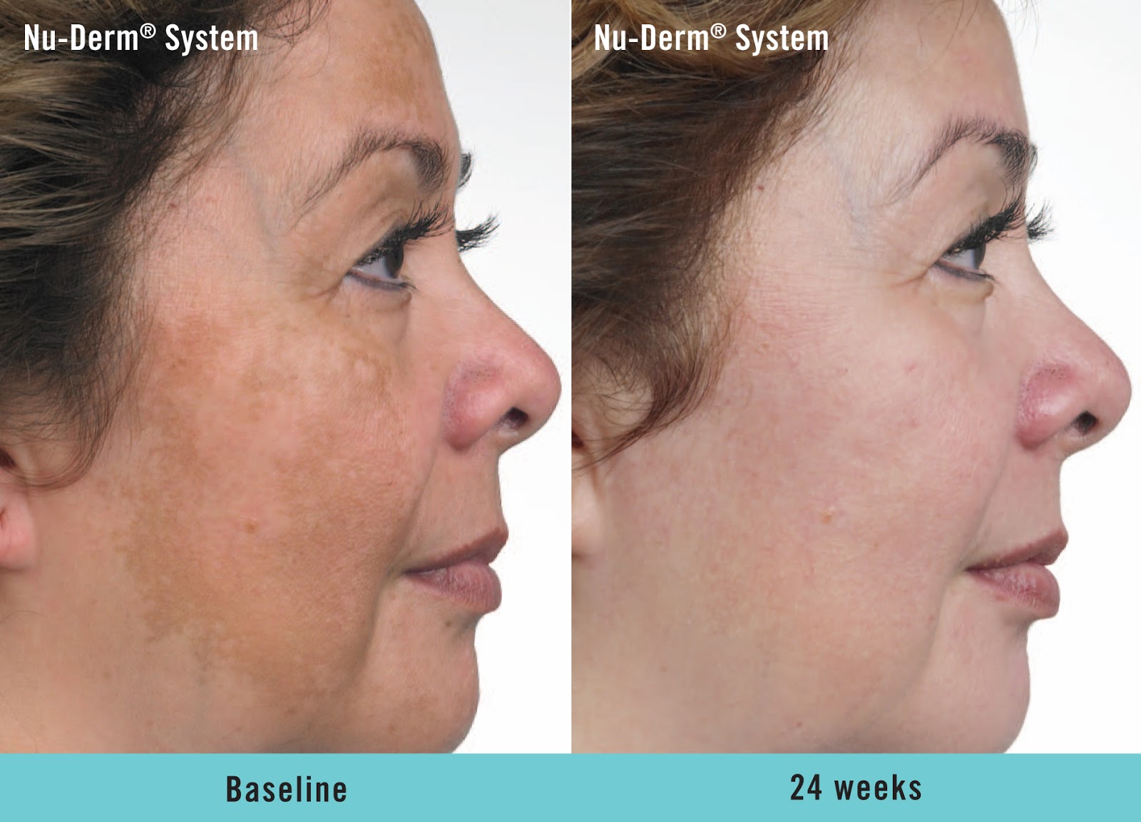 Hydroquinone Before And After