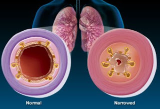 Natural Remedy for Bronchitis, a Natural Way to Cure Bronchitis