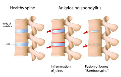  Homeopathy treatment for ankylosing spondylitis